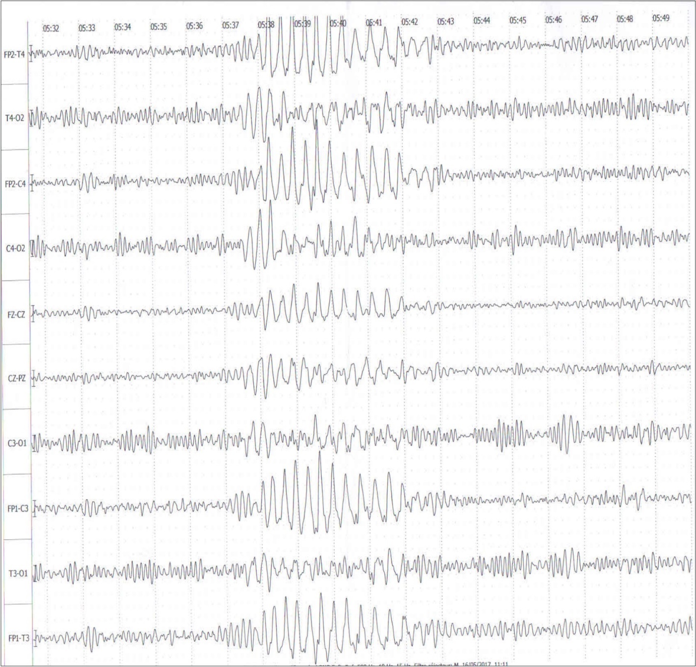 EEG Sleep records showed brief discharges of generalized slow waves and spikes