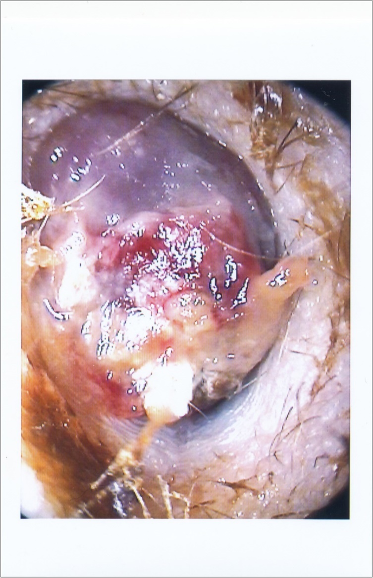 Journal of Clinical case reports and images-Lymphoma – External auditory canal – immunodeficiency