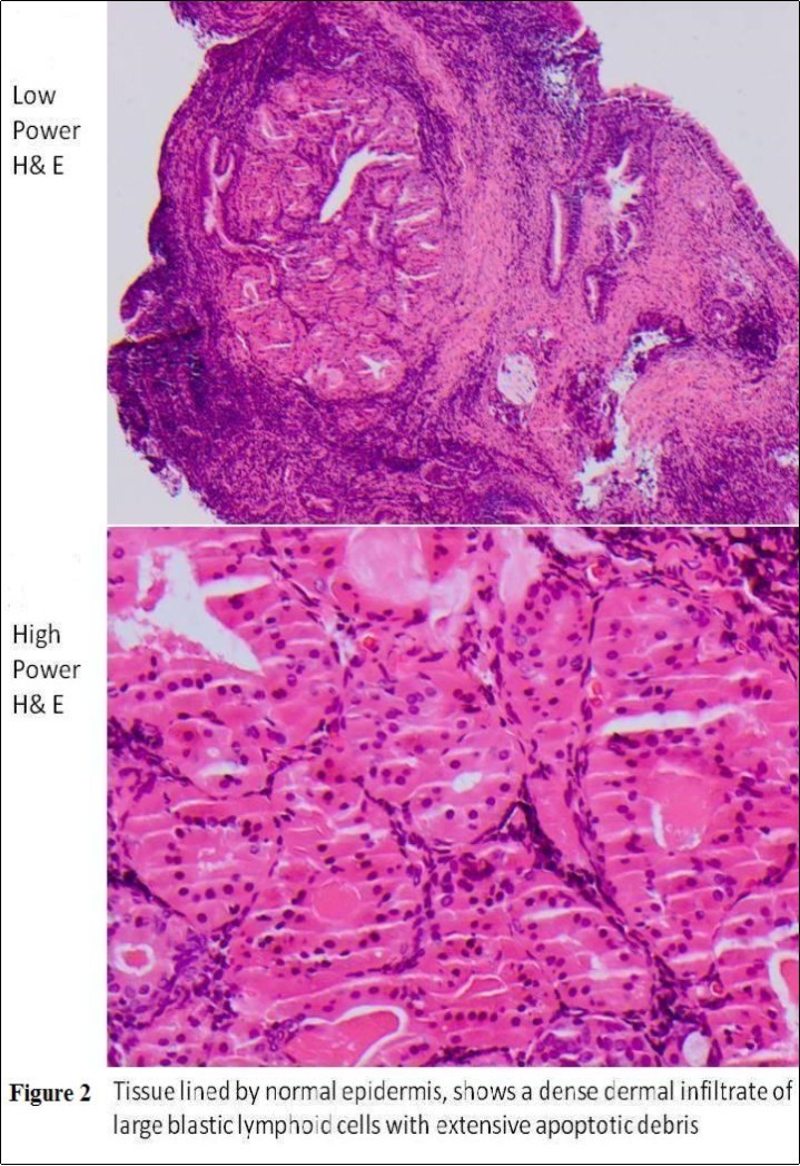 Journal of Clinical case reports and images-Lymphoma – External auditory canal – immunodeficiency