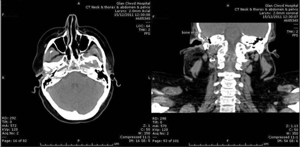 Journal of Clinical case reports and images-Lymphoma – External auditory canal – immunodeficiency