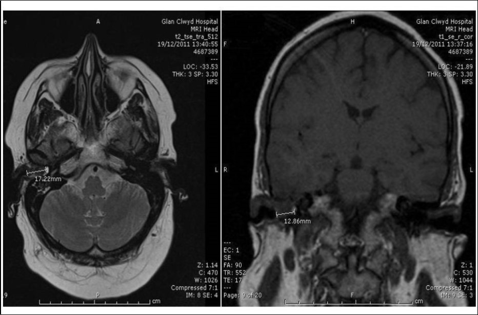 Journal of Clinical case reports and images-Lymphoma – External auditory canal – immunodeficiency