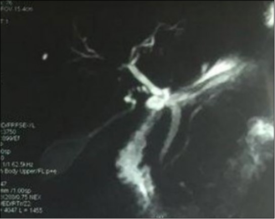 Journal of Spleen And Liver Research-Cholangitis