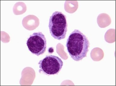 Journal of Clinical and Diagnostic Pathology-Leukaemia