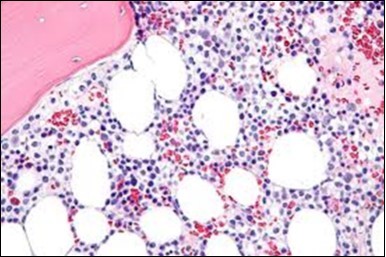 Journal of Clinical and Diagnostic Pathology-Leukaemia