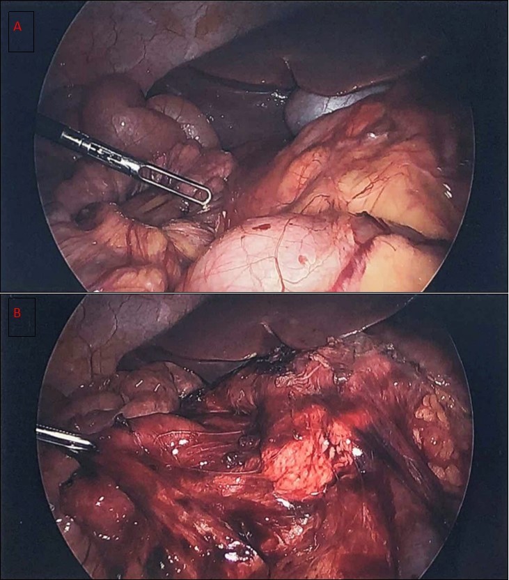 Keyhole Surgery Proceedings