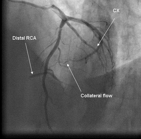 Journal of Hypertension and Cardiology-Angiography