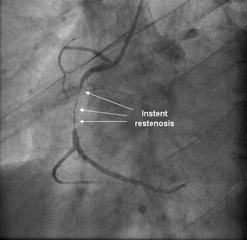 Journal of Hypertension and Cardiology-Angiography
