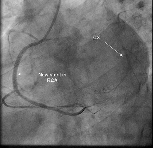 Journal of Hypertension and Cardiology-Angiography