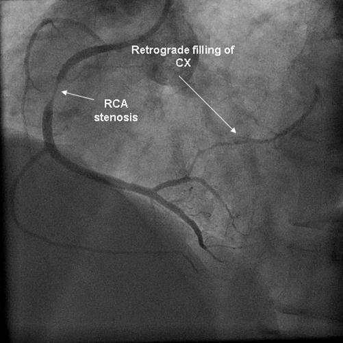 Journal of Hypertension and Cardiology-Angiography