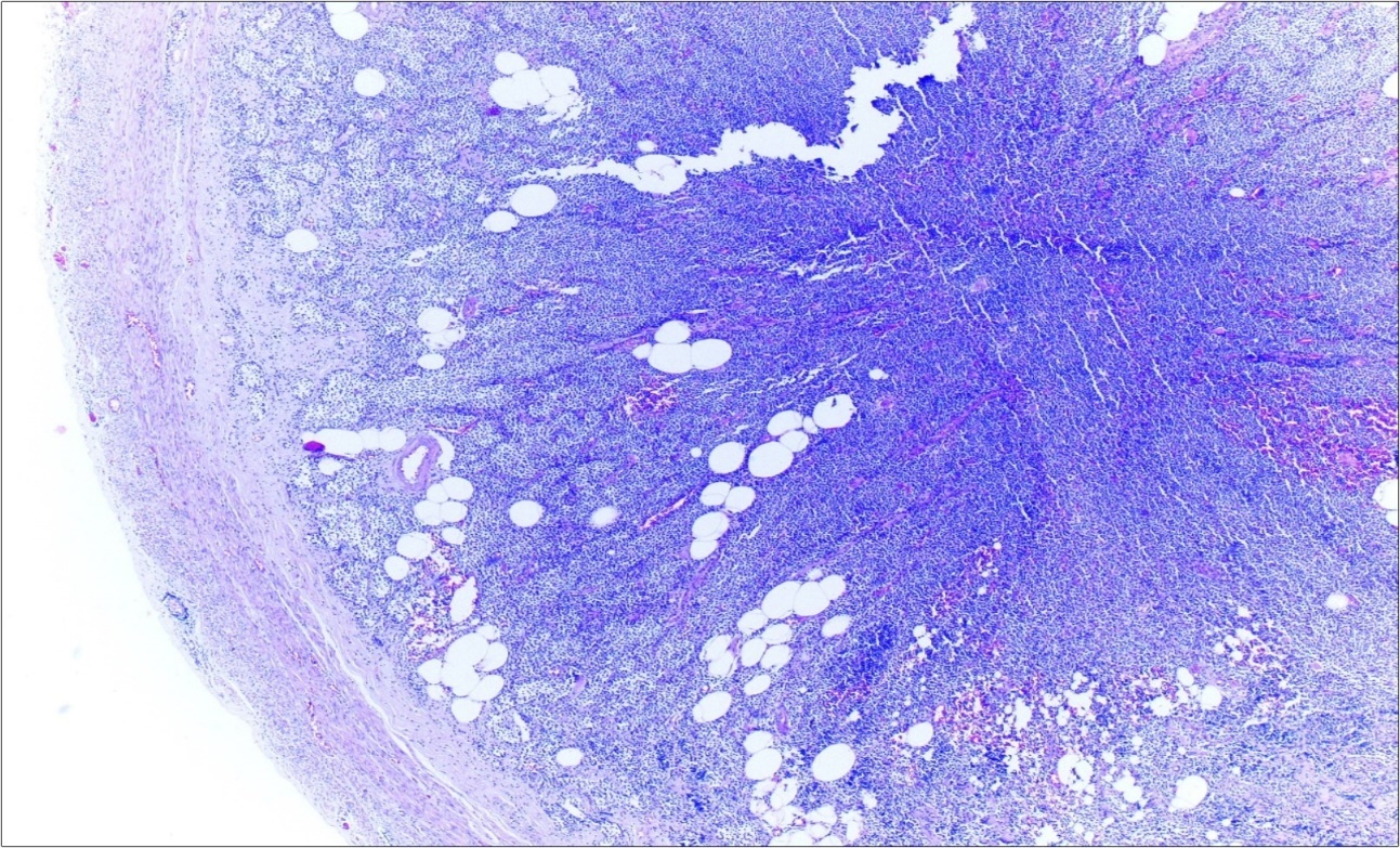 Journal of Clinical Case reports and Images-Adenocarcinoma