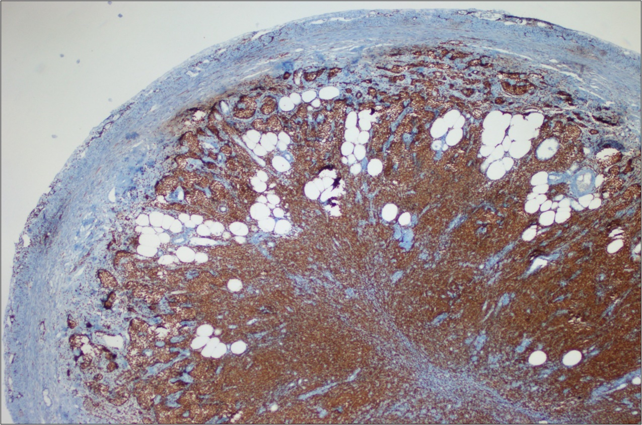 Journal of Clinical Case reports and Images-Adenocarcinoma