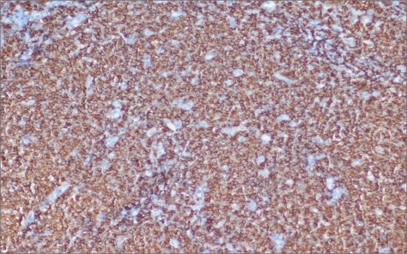 Journal of Clinical Case reports and Images-Adenocarcinoma