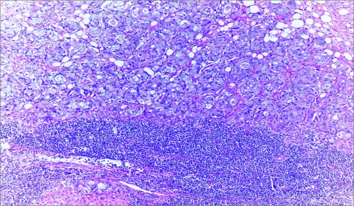 Journal of Clinical Case reports and Images-Adenocarcinoma