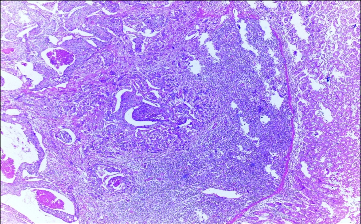 Journal of Clinical Case reports and Images-Adenocarcinoma