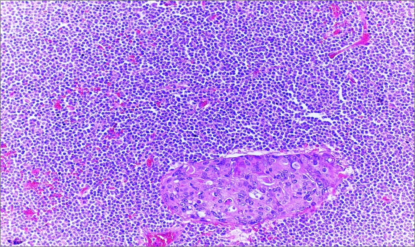 Journal of Clinical Case reports and Images-Adenocarcinoma