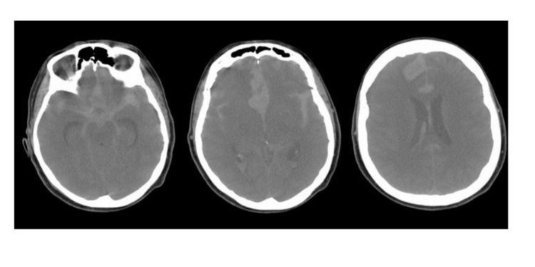 Article: Delayed Diagnosis of Glioblastoma due to Recent Ruptured Aneurysm. A Case Report.
