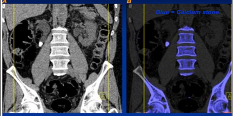 Article: Dual Energy Computed Tomography and Effect on the Management of Uric Acid Renal Calculi