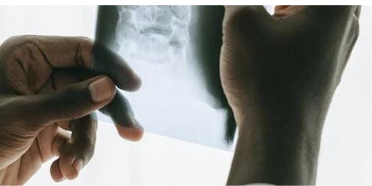 Article: Impact of Bronchiectasis on COPD Exacerbations 