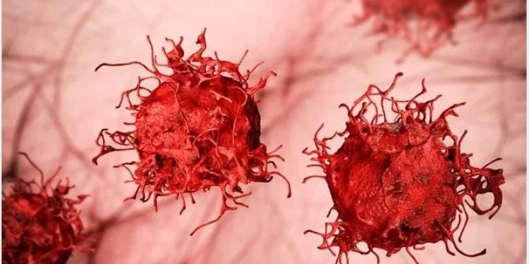 Article: Rare Lipomatous Neoplasm of The Thigh in A 13 Year Old Male with A Discussion of Imaging Features and Differential Diagnosis of A Fatty Extremity Mass