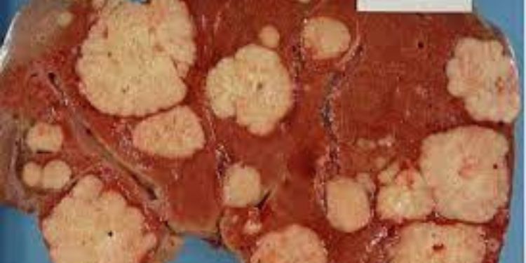 Article: Statins and Lung Cancer: A Review of Current Literature 