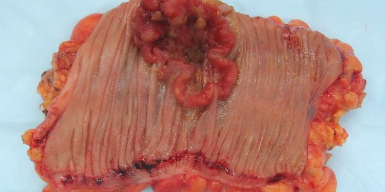 Article: Breast Cancer, Chemokines, And Metastasis: A Search for Decoy Ligands of the CXCR4 Receptor 