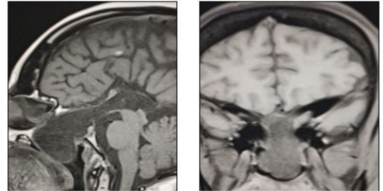 Article: A Treatable Cause of Progressive Visual Loss
