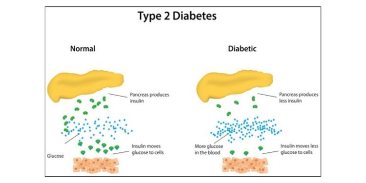 Article: The Impact of Nutrients on Diabetes