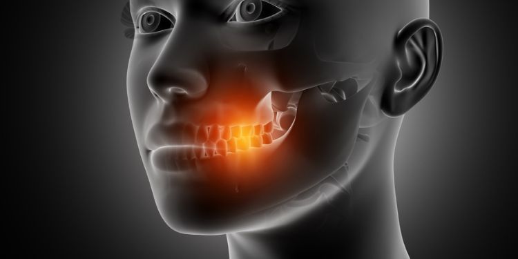 Article: Radio-Induced Maxillary Angiosarcoma: About a Case 