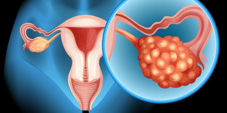 Article: Preventing Ovarian Hyperstimulation Syndrome (OHSS)