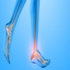 Journal of Clinical Case Reports and Images - Sural Neuritis