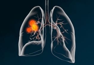 Journal of Lung Cancer Epidemiology